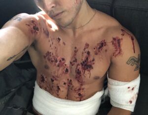 Blair Redford Instagram - BTS from this weeks episode. Make-Up FX did a great job with all these skin transfers and paint to emulate 4 shotgun blasts to Thunderbird’s bullet resistant (not proof) skin. @thegiftedonfox #marvel
