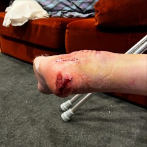 Blake Williams Instagram - 4 weeks down since some serious camber adjustment on the heel and a slight wheel alignment. All going well at this point, except the nightmares of Baltimore Dew tour 07 and eating shit doing someone that’s wasn’t necessary 🤦🏻‍♂️😂 hit up my #onlyFeet account for more VIP pics and private content 😂😂😂