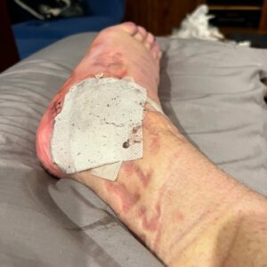 Blake Williams Instagram - 4 weeks down since some serious camber adjustment on the heel and a slight wheel alignment. All going well at this point, except the nightmares of Baltimore Dew tour 07 and eating shit doing someone that’s wasn’t necessary 🤦🏻‍♂️😂 hit up my #onlyFeet account for more VIP pics and private content 😂😂😂