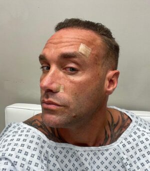 Calum Best Instagram - A big thank you to my friend and doctor @paulbanwell …

I have a fair few moles , and as a young lad I had a few removed for precaution ..
Cut to now , I’ve had a few people mention getting them checked so it’s been on my mind for years .
Finally I went to see Paul to see if I had anything to worry about , for precaution due to how a few looked we decided to take two off my face and one off my back.

Dr Paul leads the way in skin care and skin cancer knowledge In the UK so I knew I was in very safe hands, a little anaesthetic and I was numb and the job was done in minutes , face bandaged fof a week and I’m now fresh as a daisy and can now worry less !

Thank you @paulbanwell and his whole team at @seymourclinic 🤝❤️
@sa_comms