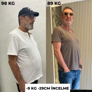 Cem Özer Instagram - @cem_ozer ile inatçı göbek yağlarında kısa sürede kurtulduk. 
Artık bölgesel yağlardan kurtulmak çok kolay çünkü Metin Akay Emshape yanınızda.  Yapmanız gereken tek şey size en yakın şubemize gelip muhteşem bir değişime başlamak.

✨ Kişiye özel özel oluşturulan program sonucudur.
✨ İhtiyacınız yönelik programlar uzman kontrolünde belirlenir.
✨ Net bilgi, program desteği ve profesyonel destek için öncelikle kontrole gelmeniz gerekir.

Ölçümlerimiz;
Alt karın bölgemiz 91CM’den 78CM’e.
Üst karın bölgemiz 109CM’den 94CM’e.
Toplamda: -29CM incelme sağlanmıştır.

Cihazlarımız FDA onaylıdır ve kişiye özel protokollerle sonuç almaktayız.

Şişli: 
📱 WhatsApp :  90 539 291 38 60
Vadistanbul:
📱 WhatsApp :  90 533 961 93 28
Levent:
📱 WhatsApp :  90 539 291 38 60