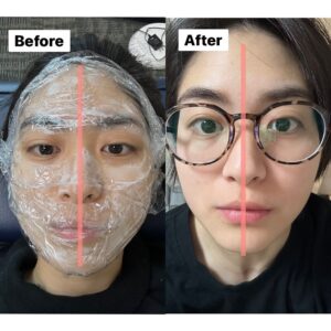 Chia-Wei Chu Instagram - 🔥醫美首次體驗就來個猛的(!)墨菲斯電波心得💓

這真的是我人生第一次施打醫美療程!有點緊張又興奮
首先會接觸這項產品是因為剛好是之前合作的廠商
有拍攝一部形象影片(不知道有沒有人看過了🤔)
再來是因為覺得自己的年紀也到了需要保養的時候
真的剛好天時地利人和耶🥺

做電波的效果好像是半年後才會開始明顯變化
原本想說 我臉上根本沒肉 應該沒什麼效果
目前術後一個月自己超級有感的地方居然是！！！
我的臉型對稱！！！！！！
不囉唆 大家直接看圖！！！
是不是真的有差！我認真嚇到😳😳
（沒想到還能校正臉型超讚的💓😍☺️

還不認識墨菲斯電波的～馬上幫大家懶人包科普：
墨菲斯電波顧名思義就是結合了「微針」與「電波」
利用微針破壞表皮和真皮組織
刺激皮膚再生反應
並藉由深入皮下的微針尖端持續釋放電波，加熱深層組織

而且墨菲斯電波是從肌膚底層釋放，加上探頭尖端擁有非絕緣設計，不會加熱到表皮，能更精準的加熱深層真皮層，可以安全地在組織中釋放更高的能量

墨菲斯不僅可以拉提下顎線條、緊緻肌膚
還能作用於凹痘疤下方的組織
改善月球表面🌕及痘疤、毛孔粗大的肌膚問題
也能藉由機器多種模式操作達到深層脂肪溶脂作用
探頭還有根據每個部位有不同的選擇塑形腹部、下巴和眼周都有對應的探頭⭐️客製化部分超加分

各個年齡階段都有在意的皮膚困境，
雖然已經被廠商說我的臉已經夠小了，但是小怎麼夠還要緊！💪🏼
墨菲斯電波能改善的狀況無論是痘疤、凹痕還是皺紋、鬆弛都是它的強項，經過肌膚破壞重組，刺激肌膚膠原蛋白增生❤️❤️

有3-5天修復期，但首次醫美的我都可以接受了😂
對其他人來說應該是小case🤗
後幾天要上班的朋朋盡量以淡妝為主唷👌🏼

這邊還要提醒一下，術後不建議冰敷，要讓電波持續作用～
冰敷有可能會影響到成效，所以多以加強保濕為主💦
（我過年瘋狂保濕🤣🤣 邊吃飯喝酒邊敷面膜🤣🤣
因為太荒謬直接被拍照紀念🤣🤣

如果你打過很多音波電波效果都不滿意
或是肌膚老化 但不想拉皮
以及有妊娠紋、在意橘皮者都很適合
聽說還是國外很多明星都在做的項目🔥🔥
#貝嫂 #小甜甜布蘭妮 
真心推薦大家可以試試看 #墨菲斯微針電波 😆

#墨菲斯微針電波 #微針電波 #墨菲斯電波 #inmode #醫美推薦 #電波推薦 ##morpheus8