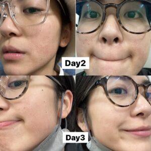 Chia-Wei Chu Instagram - 🔥醫美首次體驗就來個猛的(!)墨菲斯電波心得💓

這真的是我人生第一次施打醫美療程!有點緊張又興奮
首先會接觸這項產品是因為剛好是之前合作的廠商
有拍攝一部形象影片(不知道有沒有人看過了🤔)
再來是因為覺得自己的年紀也到了需要保養的時候
真的剛好天時地利人和耶🥺

做電波的效果好像是半年後才會開始明顯變化
原本想說 我臉上根本沒肉 應該沒什麼效果
目前術後一個月自己超級有感的地方居然是！！！
我的臉型對稱！！！！！！
不囉唆 大家直接看圖！！！
是不是真的有差！我認真嚇到😳😳
（沒想到還能校正臉型超讚的💓😍☺️

還不認識墨菲斯電波的～馬上幫大家懶人包科普：
墨菲斯電波顧名思義就是結合了「微針」與「電波」
利用微針破壞表皮和真皮組織
刺激皮膚再生反應
並藉由深入皮下的微針尖端持續釋放電波，加熱深層組織

而且墨菲斯電波是從肌膚底層釋放，加上探頭尖端擁有非絕緣設計，不會加熱到表皮，能更精準的加熱深層真皮層，可以安全地在組織中釋放更高的能量

墨菲斯不僅可以拉提下顎線條、緊緻肌膚
還能作用於凹痘疤下方的組織
改善月球表面🌕及痘疤、毛孔粗大的肌膚問題
也能藉由機器多種模式操作達到深層脂肪溶脂作用
探頭還有根據每個部位有不同的選擇塑形腹部、下巴和眼周都有對應的探頭⭐️客製化部分超加分

各個年齡階段都有在意的皮膚困境，
雖然已經被廠商說我的臉已經夠小了，但是小怎麼夠還要緊！💪🏼
墨菲斯電波能改善的狀況無論是痘疤、凹痕還是皺紋、鬆弛都是它的強項，經過肌膚破壞重組，刺激肌膚膠原蛋白增生❤️❤️

有3-5天修復期，但首次醫美的我都可以接受了😂
對其他人來說應該是小case🤗
後幾天要上班的朋朋盡量以淡妝為主唷👌🏼

這邊還要提醒一下，術後不建議冰敷，要讓電波持續作用～
冰敷有可能會影響到成效，所以多以加強保濕為主💦
（我過年瘋狂保濕🤣🤣 邊吃飯喝酒邊敷面膜🤣🤣
因為太荒謬直接被拍照紀念🤣🤣

如果你打過很多音波電波效果都不滿意
或是肌膚老化 但不想拉皮
以及有妊娠紋、在意橘皮者都很適合
聽說還是國外很多明星都在做的項目🔥🔥
#貝嫂 #小甜甜布蘭妮 
真心推薦大家可以試試看 #墨菲斯微針電波 😆

#墨菲斯微針電波 #微針電波 #墨菲斯電波 #inmode #醫美推薦 #電波推薦 ##morpheus8