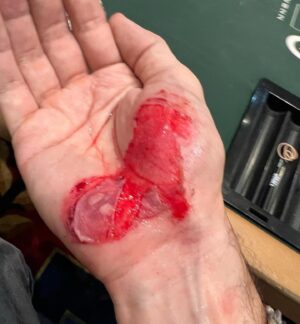 Daniel Negreanu Instagram - WSOP injury. Suspected shooter and I start running with the crowd and got trampled but at least we are safe