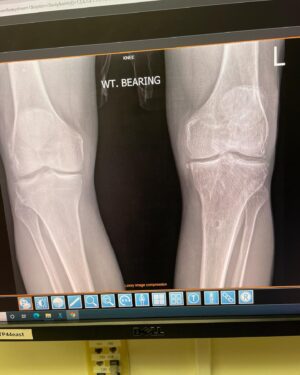 Danny Way Instagram - Seeing is believing, I’m always searching for the latest innovations with orthopedic medical science and was connected with @bioxcellerator_ through a good friend of mine @wolfmate about 2 years ago. I have had countless joint injuries and surgeries over the last 40 years and have some significant degeneration in several joints but the weight bearing joints are the most chronically painful. I have had 4 knee reconstructions on my left knee and about to have the 5th. Both of my knees have cartilage degeneration / arthritic changes from years of heavy abuse. BioXcellerator treated both knees along with every other joint in my body 14 months ago. Just prior to these treatments I had MRI scans and X-rays on every joint in my body. Here is proof of what the mesenchymal stem cells can do for degenerative joints. The first of these 2 films was shot 14 months by @dr.fabilus just prior to my treatment late June 2021 and the second film was shot 2 days ago September 9th 2022 by @dr.fabilus . The joint spacing has increased between my tibial plateau and my femoral condyle, which shows some level of cartilage regeneration in this 14 month time period and it will continue to improve for the next year or so! When I built this relationship with @bioxcellerator_ I told them I wanted to document the process and the results of my treatments and be completely transparent about the findings and they were so confident in the outcome they were happy for me to share the results. I’m so amazed by these results and very excited to be working with the most advanced scientists, doctors and business in the stem cell movement. Thank you so much @bioxcellerator_ @ericstoffers.ceo @dr.karolynnhalpert 
@dr_alejo 
@anahoyosf 
@dianis747 
@drwilliamprevite 
@dr.fabilus 
@anirpo90 
@joeygranath