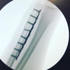 Diego Muñoz Instagram - 11 días después, haciendo abandono total del inmueble.  Sin ningun tubo conectado al cuerpo / Casi un milagro.  Gracias infinitas a todas las personas q me salvaron la vida.  Gracias❤️ Ahora a recuperarme bien.