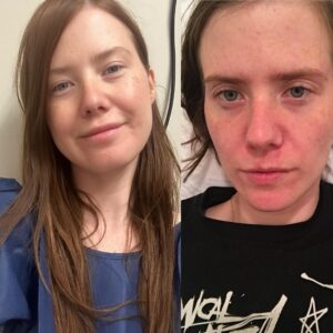 Erin Lee Carr Instagram - right: me on may 1, 2024. left: me at the peak of my illness in 2017. i finally got really good health news (knock on wood). i’ve mentioned before but i went through a horrible freak health accident that had years of consequences. in 2018, i took a breathing test, we knew it was going to be bad but didn’t know how bad. it came back and it said that i had 39% lung capacity. my doctor said i should meet with the transplant team and start the process. i did and i begged the doctors and the universe to keep me from having to do this. i immediately got out of the cold weather and drove to florida and sat as still as possible in the sunshine. i went to doctors, i took the medicine, i used my oxygen tank and crystals and did acupuncture. and somehow, over the years a sort of miracle happened. i got better, through sheer dumb luck and finally have made it back to having 71% lung capacity. wow. thanking the universe for letting me live in an independent way. sometimes stuff does not work out but sometimes it does. feeling so grateful.