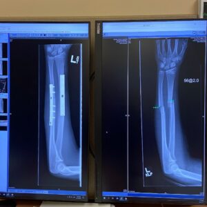 Gracyn Shinyei Instagram - A before and after of my arm without plates and with plates and screws! I’m on the mend now and hopefully will have a speedy recovery!💪💗