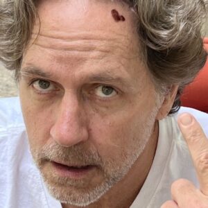Guy Ecker Instagram - Qué onda? La dermatóloga me quemó una verruga o me tatúo un corazón?!