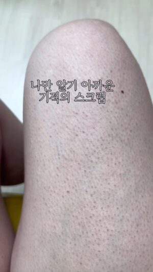 Heo An-na Instagram - <마감4시간 전>뭘 해도 안 없어지던 모공각화증 사라진 스토리

얼굴에만 쓰던 스크럽을 출근 준비를 하면서 
바디워시 대신 썼어유!

뭘 기대하고 쓴게 아니거 미라클워시 하나로 
스크럽부터 클렌징까지 다 가능하다니까! 
시간 없으니까! 쓴 거 뿐인데

어느날 문득 허벅지가 보들보들🤣🤣

깜짝 놀라서 바로 영상 찍어봤는데
술취해서 찍어뒀던 모공각화증 사진이랑
비교를 해보니 오마이갓😭😭😭😭

이거 필터/보정 1도 없이 쌩카메라에요!
제 털들 보시면 아시겠죠??ㅋㅋㅋ

왜 내가 진짜 살다살다 모공 각화증까지 
커밍아웃을 하고 앉아 있겠어!!!

진짜니까! 거짓부렁이 1도 안섞였으니까아‼️
찐템이라 이거야😎😎😎😎‼️

모공각화증으로 고생하는 수락이들 이거다‼️‼️‼️
이거 언니 실화다‼️‼️‼️‼️‼️

12시 정각 공구 마감합니다!!!
까먹지말어!!!!!!! 제발~~~~~~😭

#모공각화증
#포레스타미라클스크럽
#스크럽