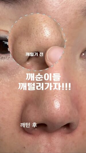 Heo An-na Instagram - #공구OPEN #이벤트마감🙋‍♀️깨순이/딸기공주 모여!먼저 써볼 사람
#포레스타미라클워시 

깨순이들 나랑 같이 스크럽 써볼래?? 
✔️좋아요 누르고 댓글 써줘 추첨할게!

⭕️스쿠로우스알갱이로 저자극 롤링
⭕️연어PDRN이 들어간 스크럽 봤어?
⭕️바디스크럽 아니고 온 몸 스크럽! 얼굴에도 매일사용 가능
⭕️포레스타 샴푸와 함께 두피 각질 관리에도 최고임

수락이들 미리 사과부터 할께! 나 없으면 불안해지는 
불안템 또 가지고 왔잖아!

겨울부터 꾸준히 사용하고 있는 스크럽인데
이제 여름이잖아?? ㅠㅠ 더워서 어쩔 수 없이 
반팔, 반바지 입으면 뻔히
거무튀튀한 팔꿈치/ 무릎  보일 거 아니야아😫😫😫
내 허벅지 모공 각화증 어째~~각질 관리 해야되잖아!!! 귀찮아!!

자중해!! 수락이들!! 요거 하나면 되거든??

✅일단 먼저 써보라고 30명 추첨해서 선물 보내줄게!

영상 봤지? 내 블랙헤드 빠지는거! 
저거 한 번 만에 저렇게 된거야!
바로 오늘 아침에 일어나서 세수 한 번하고 
찍은 영상임 대박이지?

여튼 나 썰 풀거 너무 많은데 
차차 풀도록 할께!!

나랑 일단 같이 써보자고!!

왜 포레스타미라클워시를 써야하는지 이유를 
좋아요❤️와 함께 댓글에 적어줘! 

댓글 추첨해서 30명에게 오늘 밤 당첨DM보낼거얌
이름/상세주소/전화번호까지 보내주면 됨
알았지?? 금방 만나~~~~

#스크럽
#포레스타
#포레스타스크럽