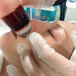 Hsuan-yen Tsai Instagram - 做完黑鑽水飛梭之後當天的素臉。

這台機器擁有360度旋轉的矽膠探頭，矽膠探頭非常親膚，除了帶走老舊角質和髒污，還同時注入精華液來清潔毛孔、滋潤提亮膚質。非常適合容易紅腫過敏的膚質。
你看看這光芒，有夠亮捏！

#黑鑽水飛梭 #dermaclear #保養 #清潔
