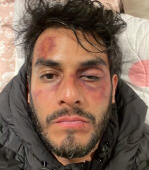 Hugo Catalán Instagram - Un día recibí una llamada de @juanosorio.oficial invitándome al proyecto que estaba por comenzar! Fui a verlo y Juan es de esas personas tan apasionadas e intensas que a los pocos minutos yo ya estaba montándome a una montaña rusa que se llamó @elamornotienerecetaof que termina hoy al aire en México pero continúa en otras partes del mundo ! Me llevo maravillosos recuerdos! Fue un placer compartir a lado de gente extraordinaria! Tanto @claudia3martin como @danielelbittar hicieron un trabajo extraordinario como protagonistas y el resto de actores fueron unos grandes compañeros! Muchas felicidades por el gran éxito! Fue una montaña rusa y creo que nunca había estado tan golpeado en la vida! Pero que bueno que les gustó mi trabajo como Fermín! Hasta la próxima ❤️😘