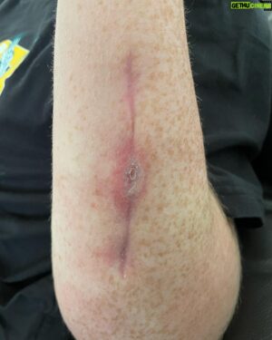 Jack Della Maddalena Instagram - Had surgery on my arm 1 week after 299. 10 days later my wound had began splitting. Which was indicative of infection.  Went in for surgery 2 as believed to be infection present, bone cleaned plate replaced, stayed in hospital for 9 days on IV antibiotics then moved to oral antibiotics. Thought the infection was under control, the wound itself had a couple of abscesses pop up over a 5 week period which had been cut and drained which had bacteria present. (Slide 3) abscess cut and wound was covered. (Slide 4) 27th May  removed the covering to show a messy hole. Had a further surgery yesterday to remove infected tissue and unfortunately some infected bone. I am going to have a further surgery or two to remove further infected tissue over the next week.

Unfortunately this means I won’t be competing at UFC 305 in Perth. Which is a tough pill to swallow. At the moment I am focused on recovery, Ridding my body of infection and allowing the bone to mend. planning to get my arm back to 100% which if all goes well will be in 12 weeks time. I am still motivated to compete before the years end in the fight I believe is the toughest and makes the most sense.