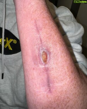 Jack Della Maddalena Instagram - Had surgery on my arm 1 week after 299. 10 days later my wound had began splitting. Which was indicative of infection.  Went in for surgery 2 as believed to be infection present, bone cleaned plate replaced, stayed in hospital for 9 days on IV antibiotics then moved to oral antibiotics. Thought the infection was under control, the wound itself had a couple of abscesses pop up over a 5 week period which had been cut and drained which had bacteria present. (Slide 3) abscess cut and wound was covered. (Slide 4) 27th May  removed the covering to show a messy hole. Had a further surgery yesterday to remove infected tissue and unfortunately some infected bone. I am going to have a further surgery or two to remove further infected tissue over the next week.

Unfortunately this means I won’t be competing at UFC 305 in Perth. Which is a tough pill to swallow. At the moment I am focused on recovery, Ridding my body of infection and allowing the bone to mend. planning to get my arm back to 100% which if all goes well will be in 12 weeks time. I am still motivated to compete before the years end in the fight I believe is the toughest and makes the most sense.