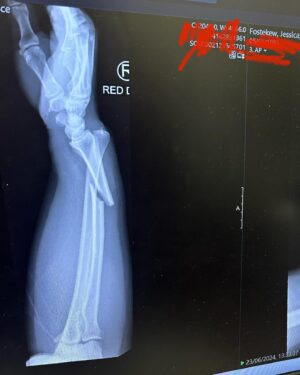 Jessica Fostekew Instagram - ⚠️ this post contains a gross x-ray of my snapped arm bones 🩻 ⚠️

I won’t be posting any 🏋🏻‍♀️ for a while 😢 

On Sunday I broke the fuck out of my wrist and arm trying to learn a new gymnastic movement called a pull-over. KIDS: DON’T USE GRIPS FOR PULLOVERS PLZ. My body went over but my hands didn’t 🤮 

It was bad bad. I’m a twit for using grips for that movement but it was new and I just didn’t have a clue. Ugh. 

A man called Hugh at my gym is a guardian angel. He took me to hospital and stayed with me all day and evening then collected my car 🦸🏻‍♂️❤️

Big shout out to amazing @lg_nhs for taking incredible emergency care of me. On Tuesday I had surgery with a plate, pins AND a wire whacked in there 🦾

I’ve had so many kind kind things from friends I’m touched as absolute fuck 💐 

I’m 💔 to have lost an exciting acting job I had coming up (fairly, my character would have needed to have a broken arm for ten years 😂). But I’m already back to work in every other respect ✌🏻

Also left-only-handed lyf is ON. I’ve learnt left handed writing, injecting my own tummy with one hand and today I chopped up a BUTTERNUT SQUASH. I WILL NOT BE DEFEATED.

And my beloved PE. I’m gonna get such a fucking massive left arm and become the fastest bastard on a static 🚲 you’ve ever met. 

I’ll also have loads of therapy, naturally. 

Onwaaaaaaaaards (really fucking slowly)