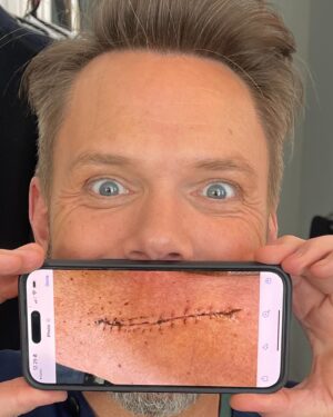 Joel McHale Instagram - My brother Stephen’s leg is just fine! He totally “Midsommared” it(if you know what I mean). After a ski jumping incident at @palisadestahoe he’s on the mend. But boy oh boy, you did it brother. Feel better and better. I’ll be up to have some #plinytheyounger as soon as you’re ambulatory. @russianriverbrewingofficial #midsommar