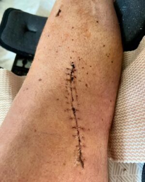 Joel McHale Instagram - My brother Stephen’s leg is just fine! He totally “Midsommared” it(if you know what I mean). After a ski jumping incident at @palisadestahoe he’s on the mend. But boy oh boy, you did it brother. Feel better and better. I’ll be up to have some #plinytheyounger as soon as you’re ambulatory. @russianriverbrewingofficial #midsommar