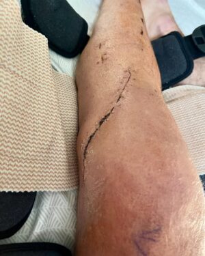 Joel McHale Instagram - My brother Stephen’s leg is just fine! He totally “Midsommared” it(if you know what I mean). After a ski jumping incident at @palisadestahoe he’s on the mend. But boy oh boy, you did it brother. Feel better and better. I’ll be up to have some #plinytheyounger as soon as you’re ambulatory. @russianriverbrewingofficial #midsommar