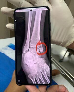 Joseph Angelo Instagram - When I broke my ankle in December, the doctor told me that I needed 2 metal screws inserted into my bone and if I don’t go through with the surgery then I might never fully heal. 

The recovery time will take at least 4-5 months not including 8 weeks physiotherapy, and the damage will cost me over 200K (ur boy don’t have health insurance lol)

I then went to visit this man (left) and he told me that if I skip surgery and spend sometime with him instead, then in a months time I’ll be able to walk again guaranteed..

Now who do you think I’m going to listen to? The actual doctor with a PhD in orthopedics, that works at a prestigious private hospital? OR the man with a fat belly?

Then you’re damn right I’m going to choose the fatman.
I told him I’m putting my whole faith in him and that I’ll bite my tongue, endure the pain and do WHATEVER he tells me

- Walk in circles (on broken foot)
- Foot presses with his feet (on broken foot)
- Foot rubs with “magic sauce” oil
- Daily intake of vitamin c-lookalike pills (could be placebo)
- Tickle fights (don’t ask)

In over 1 month, I was able to walk and run normally again.
It’s now been 4 months and I’m 100% recovered 💪🏽💯

Would I recommend this treatment to you? Yes and No.
It really depends on the severity of your injury.

But I do recommend to always see a doctor and get a second opinion from a qualified specialist. Health should always be NUMBER 1 priority, because no amount of money can buy that back once it’s gone. With that said, I chose to take a leap of faith (I already took a leap off a cliff to get here, so why the fuck not)

And the crazy thing about all of this, is that his service is free. He even let me rub his pot belly for good luck 🍀

Thank you fat belly man x