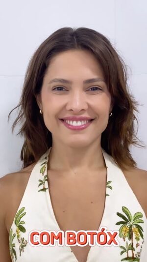 Juliana Vasconcelos Póvoas Instagram - Bora começar o ano com um botóx pra manter a carinha de plenitude? 🙋🏻‍♀️

Fiz esse vídeo após o retorno de 15 dias da aplicação do botox e olha que resultado fantástico 💖 o botox preventivo se antecipa em proibir que as rugas estáticas morem no seu lindo rostinho! É um dos melhores tratamentos a se fazer 😉

📅 ᴘᴀʀᴀ ᴀɢᴇɴᴅᴀʀ ᴀ sᴜᴀ ᴀᴠᴀʟɪᴀçãᴏ, ᴇɴᴛʀᴇ ᴇᴍ ᴄᴏɴᴛᴀᴛᴏ ɴᴏ ʟɪɴᴋ ᴅᴏ ᴘᴇʀғɪʟ

⚠️ ғᴏᴛᴏ ᴘᴏsᴛᴀᴅᴀ ᴍᴇᴅɪᴀɴᴛᴇ ᴀᴜᴛᴏʀɪᴢᴀçãᴏ ᴅᴏ ᴘᴀᴄɪᴇɴᴛᴇ

⚠️ ᴏꜱ ʀᴇꜱᴜʟᴛᴀᴅᴏꜱ ᴠᴀʀɪᴀᴍ ᴅᴇ ᴘᴇꜱꜱᴏᴀ ᴘᴀʀᴀ ᴘᴇꜱꜱᴏᴀ, ᴅᴇᴘᴇɴᴅᴇɴᴅᴏ ᴅᴏ ᴍᴇᴛᴀʙᴏʟɪꜱᴍᴏ ᴇ ᴄᴜɪᴅᴀᴅᴏꜱ ᴅᴇ ᴄᴀᴅᴀ ᴜᴍ

#harmonizaçãofacial #harmonizacaofacial #harmonizaçãofacialniteroi #fiosdepdo #botox #preenchimentolabial #preenchimentolabialniteroi #botoxrj #preenchimento #bioestimuladoresdecolágeno