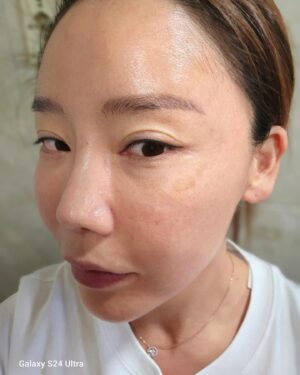 Lee Chae-dam Instagram - " 덕소엔비의원 " 에서 3차!!!!! 피코토닉하고 기미,잡티,흉터 실펌x를 3차 하고 왔어요 한달만에~ 너무너무 깨끗해졌쥬~^^
