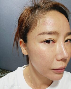 Lee Chae-dam Instagram - " 덕소엔비의원 " 에서 3차!!!!! 피코토닉하고 기미,잡티,흉터 실펌x를 3차 하고 왔어요 한달만에~ 너무너무 깨끗해졌쥬~^^