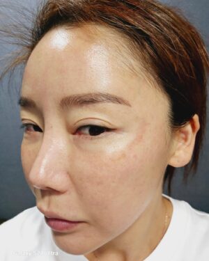 Lee Chae-dam Instagram - " 덕소엔비의원 " 에서 3차!!!!! 피코토닉하고 기미,잡티,흉터 실펌x를 3차 하고 왔어요 한달만에~ 너무너무 깨끗해졌쥬~^^