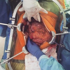 Leigh Holland-Keen Instagram - ⚠️SENSITIVE CONTENT WARNING - PLEASE DO NOT SWIPE IF YOU DO NOT WANT TO SEE SURGERY PICTURES DURING OPERATION ⚠️ 

The peritonectomy team at St George Hospital did an amazing job of removing this mass, it was entwined with my bowel and attached to my kidney and abdominal wall. So thankful for Professor Morris and all his hard working team ❤️. 

It's amazing what medical professionals can do and it's amazing what the human body can endure. 

EDIT ⚠️ - Slide 1 & 2 show the tissue wrapping around the bowel and kidney. The last slide shows the mass on the right side - that big 1kg of cancer is NOT supposed to be there. 
#surgery #bowelresection #postoprecovery #peritonectomy #feelinggrateful #strongwoman #humanbody #medical #sensitivecontent  #rebuildbyleigh #resilience