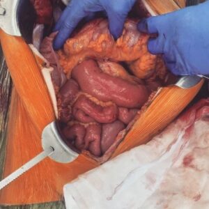 Leigh Holland-Keen Instagram - ⚠️SENSITIVE CONTENT WARNING - PLEASE DO NOT SWIPE IF YOU DO NOT WANT TO SEE SURGERY PICTURES DURING OPERATION ⚠️ 

The peritonectomy team at St George Hospital did an amazing job of removing this mass, it was entwined with my bowel and attached to my kidney and abdominal wall. So thankful for Professor Morris and all his hard working team ❤️. 

It's amazing what medical professionals can do and it's amazing what the human body can endure. 

EDIT ⚠️ - Slide 1 & 2 show the tissue wrapping around the bowel and kidney. The last slide shows the mass on the right side - that big 1kg of cancer is NOT supposed to be there. 
#surgery #bowelresection #postoprecovery #peritonectomy #feelinggrateful #strongwoman #humanbody #medical #sensitivecontent  #rebuildbyleigh #resilience