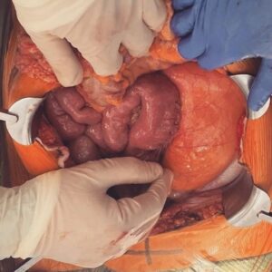 Leigh Holland-Keen Instagram - ⚠️SENSITIVE CONTENT WARNING - PLEASE DO NOT SWIPE IF YOU DO NOT WANT TO SEE SURGERY PICTURES DURING OPERATION ⚠️ 

The peritonectomy team at St George Hospital did an amazing job of removing this mass, it was entwined with my bowel and attached to my kidney and abdominal wall. So thankful for Professor Morris and all his hard working team ❤️. 

It's amazing what medical professionals can do and it's amazing what the human body can endure. 

EDIT ⚠️ - Slide 1 & 2 show the tissue wrapping around the bowel and kidney. The last slide shows the mass on the right side - that big 1kg of cancer is NOT supposed to be there. 
#surgery #bowelresection #postoprecovery #peritonectomy #feelinggrateful #strongwoman #humanbody #medical #sensitivecontent  #rebuildbyleigh #resilience