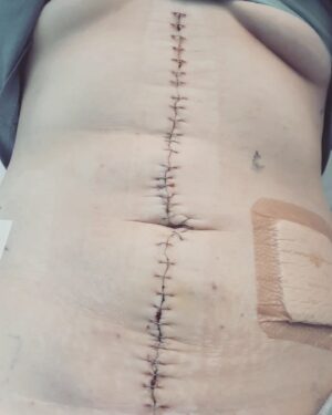 Leigh Holland-Keen Instagram - 3 weeks ago I underwent some pretty brutal surgery, surgery that I knew was risky but had to be done. I went to sleep after being told they would have to remove my left kidney, spleen, left ovary, part of my bowel, the 1kg liposarcoma and I'd have a "chemo washout" . I was so scared. It is so daunting being on your own and being faced with this. I also had an epidural prior to being sedated which brought back horrible memories of my birth but the team made me as comfortable as possible and gave me alot of reassurance which helped me in so many ways. 
.
.
I was extubated early as the surgery went well and I'm "fit and healthy" , the tumor was removed much easier than anticipated and they managed to keep the majority of my organs. I woke up with drips and drains coming out of everywhere - Arterial lines, central line, indwelling catheter, 2 abdominal drains, nasogastric tube, 3 intravenous cannulas, TPN, epidural infusion, and an oxycodone PCA. 
.
.
The next day, I had a cardiac arrest requiring CPR - I came round to a busy room full of medical staff racing around, working hard. I was told I would need a temporary pacing wire and the possibility of a pacemaker being inserted. After discussions with the cardiologist- they wanted to monitor me but attached to the defibrillator, an echocardiogram showed I have a bicuspid aortic valve with regurgitation (something I wasn't aware of). 
.
.
After 5 or 6 days in ICU I was finally moved to the ward - a few days in I developed an acute onset of new pain - I'd rather have back to back births than this pain again - I had an urgent CT at midnight to show I had pancreatitis. I was started on a continuous ketamine infusion which unfortunately made me hallucinate and I became agitated - that was stopped within 24hrs. After a couple of days things started to settle. Day by day, more drips and drains were being removed. I was in bed for 12 days so mobilising feels very weird and wobbly. 
.
.
This has certainly changed me - physically and mentally. I'll grow from this, I know it - but first I need to focus on getting my independence back and allowing myself to heal.
