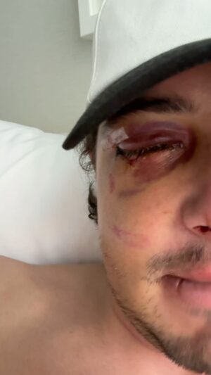 Mark McMorris Instagram - 2 WEEKS! Every time I’ve been injured, I’m constantly reminded of our body’s incredible ability to heal itself. I’m baffled to think it’s only been two weeks since my surgery/construction project on my face 😅

I’m still extremely numb on the right side of my face due to the nerve damage, but I remember this from my jaw surgery. There’s no real timeline on when and if those nerves will heal, but I’m keeping faith and my fingers crossed 🤞

I appreciate everyone sending love over the past few weeks, and I will continue putting my best foot forward on this healing journey‼️❤️