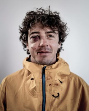 Mark McMorris Instagram - What I thought was a black eye turned out to be a more severe injury. On Monday, I underwent surgery at VGH to have my orbital bone and nose repaired. Dr. Brown and his team did a stellar job, and I’m now officially on the mend. Thank you all for the kind messages and healing vibes! It means a lot❤️ Most of all, thank you to all of my partners who have had my back through this! @redbull @burton @oakley @nike @redbullcanada @burtonsnowboards