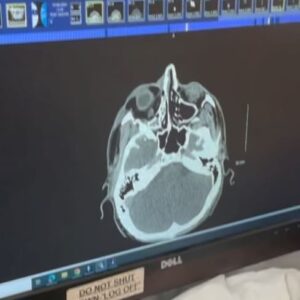 Mark McMorris Instagram - What I thought was a black eye turned out to be a more severe injury. On Monday, I underwent surgery at VGH to have my orbital bone and nose repaired. Dr. Brown and his team did a stellar job, and I’m now officially on the mend. Thank you all for the kind messages and healing vibes! It means a lot❤️ Most of all, thank you to all of my partners who have had my back through this! @redbull @burton @oakley @nike @redbullcanada @burtonsnowboards
