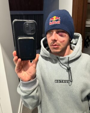 Mark McMorris Instagram - What I thought was a black eye turned out to be a more severe injury. On Monday, I underwent surgery at VGH to have my orbital bone and nose repaired. Dr. Brown and his team did a stellar job, and I’m now officially on the mend. Thank you all for the kind messages and healing vibes! It means a lot❤️ Most of all, thank you to all of my partners who have had my back through this! @redbull @burton @oakley @nike @redbullcanada @burtonsnowboards