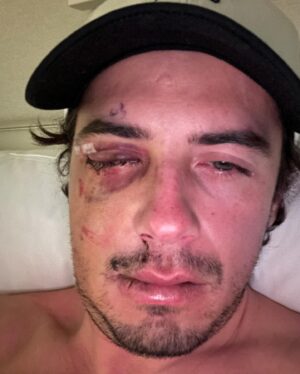 Mark McMorris Instagram - What I thought was a black eye turned out to be a more severe injury. On Monday, I underwent surgery at VGH to have my orbital bone and nose repaired. Dr. Brown and his team did a stellar job, and I’m now officially on the mend. Thank you all for the kind messages and healing vibes! It means a lot❤️ Most of all, thank you to all of my partners who have had my back through this! @redbull @burton @oakley @nike @redbullcanada @burtonsnowboards
