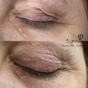 Martina Urban Instagram - Plasma Lift Skin TighteningTreatment 💫  When performing a Skin Tightening procedure, we use a device called a Plasma Pen, which emits energy that reacts with ions in the air.This reaction creates a micro bolt of plasma energy that penetrates the skin and stimulates fibroblast cells to boost collagen and elastin. You’ll see a difference right away. However, your skin will keep working to produce more collagen, providing full results after a few months. These results will last for a few years 😍

#plasmapen#skintreatment#nonsurgicaleyelift#phiiontreatments#saggyskintreatment