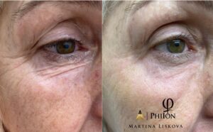 Martina Urban Instagram - Phiion plasma treatment is really amazing, these results speak for themselves! 
Because Phiion Plasma Fibroblast Skin-Tightening treatment is based on producing new collagen and elastin, we can use it on almost every area of the body that has loose saggy skin.
We can also treat areas where we want to rejuvenate the skin, make the skin tighter, and stretch marks & scars less visible. 😍