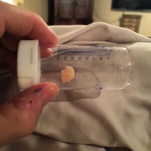 Mike Huckabee Instagram - My Thanksgiving?  Thankful to get this bone chip surgically removed from my knee this morning. I'd rather be duck hunting but won't miss any campaign events.  Happy Thanksgiving!
