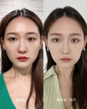 Mu Tung Chi Instagram - 在 @mumuskinn 打完肉毒後，就飛日本玩了✈️

我的咀嚼肌摸過的都說超級大！沒在開玩笑🤣
詳情請見圖2😀
我正臉看起來偏圓，笑起來就會整個超像肉餅^_^..
肉毒小臉後，臉部線條變得清晰，視覺直接瘦3公斤有吧..😍
在木木日安，局部冰敷後直接打，居然沒什麼痛感，專業又快速～
在敦化南路上，診所低調的奢華，工作人員溫柔接待毫無壓力之外，
醫生也很細心溝通我的要求～讓我非常安心
#木木日安 大推💗
