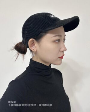 Mu Tung Chi Instagram - 來分享去年12月初到 @wbeauty.clinic 打了音波拉提
音波真的太適合我的臉了~
肉肉臉容易下垮，施打完1.2個月後就有明顯拉提，輪廓線變得超明顯
正臉照鏡子從圓臉變成小V臉
連男友都問說我是不是瘦了，但其實根本沒有…^_^
而且剛打完的皮膚那陣子都特別細緻
完全不是錯覺！！是肉眼可見的改變，真的愛瘋😍

英爵醫美使用的是美國機 #Ulthera極限音波
通過美國和台灣FDA雙認證✔️
聚焦式超音波治療，深度達4.5mm，能作用到SMAS筋膜層，
刺激膠原蛋白増生，達到提拉緊緻的效果！

其實很多人以為音波打越多發數，效果就越好，
但其實最重要的是針對你的需求，和想改善的肌膚問題施打
這次幫我治療的是 #謝易霖副院長
他會依照每個人的肌膚年齡，建議適合的療程範圍，打在最需要加強的位置
事前評估很重要，經驗跟醫生的專業度，才能美得更自然💯

來說一下施打過程✨
雖然不是第一次打音波，但還是有點怕痛
幸好護理師有事先幫我準備止痛藥及敷麻藥
施打過程還有壓力球可以捏
謝醫師會時刻關心我的狀況
護理師姊姊也很溫柔在旁邊幫我加油打氣
另外很重要的是，這次要施打的療程包裝是現場拆封，讓我覺得安全又有保障💓

這次好閨蜜要在峇里島結婚，我瘋狂推薦她趕快進場維修，
除了英爵讓我感受度真的很好之外，音波真的太值得投資了！！💖

#英爵醫美 #音波拉提 #音波 #美國機 #Ulthera