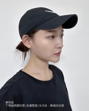 Mu Tung Chi Instagram - 來分享去年12月初到 @wbeauty.clinic 打了音波拉提
音波真的太適合我的臉了~
肉肉臉容易下垮，施打完1.2個月後就有明顯拉提，輪廓線變得超明顯
正臉照鏡子從圓臉變成小V臉
連男友都問說我是不是瘦了，但其實根本沒有…^_^
而且剛打完的皮膚那陣子都特別細緻
完全不是錯覺！！是肉眼可見的改變，真的愛瘋😍

英爵醫美使用的是美國機 #Ulthera極限音波
通過美國和台灣FDA雙認證✔️
聚焦式超音波治療，深度達4.5mm，能作用到SMAS筋膜層，
刺激膠原蛋白増生，達到提拉緊緻的效果！

其實很多人以為音波打越多發數，效果就越好，
但其實最重要的是針對你的需求，和想改善的肌膚問題施打
這次幫我治療的是 #謝易霖副院長
他會依照每個人的肌膚年齡，建議適合的療程範圍，打在最需要加強的位置
事前評估很重要，經驗跟醫生的專業度，才能美得更自然💯

來說一下施打過程✨
雖然不是第一次打音波，但還是有點怕痛
幸好護理師有事先幫我準備止痛藥及敷麻藥
施打過程還有壓力球可以捏
謝醫師會時刻關心我的狀況
護理師姊姊也很溫柔在旁邊幫我加油打氣
另外很重要的是，這次要施打的療程包裝是現場拆封，讓我覺得安全又有保障💓

這次好閨蜜要在峇里島結婚，我瘋狂推薦她趕快進場維修，
除了英爵讓我感受度真的很好之外，音波真的太值得投資了！！💖

#英爵醫美 #音波拉提 #音波 #美國機 #Ulthera