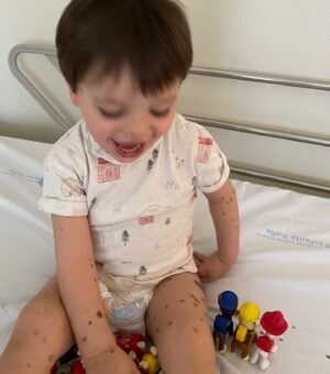 Nira Juanco Instagram - Hoy es el día Mundial de las enfermedades raras. 
Hay unas 7.00 diagnosticadas que afectan al 7% de la población mundial.
Mi hijo Daniel tiene una de ellas, Nevus Melanocítico Congénito Gigante. Es una malformación en la piel que no se sabe por qué sucede. A la hora de repartirse la pigmentación de la piel en el primer trimestre de embarazo, hay una anomalía que hace que salgan estas manchitas siendo alguna de ellas “gigante”.
Daniel está bien. Afortunadamente, en su caso es un tema estético y de revisión constante toda su vida y con mucho cuidado con el sol.
Ayudemos a la investigación y difusión de estas enfermedades y normalicemos que no todos somos iguales.
#bareyourbirthmark #enfermedadesraras @fernandomeco 
@monographica.brand