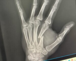 Omar Antonio Morales Ferrer Instagram - Tuve una lucha con mi mente desde el primer round, no sabía si iba a lograr terminar el combate con una mano fracturada, ni siquiera le comenté a mi esquina lo que estaba sucediendo, olvidé por completo mi estrategia, solo quería terminar la pelea antes de los 3 rounds buscando golpes de poder, me sentí bastante estresado, sabía que esta lesión me podía llevar a la derrota, cosa que no iba aceptar.

Ya he visto la pelea varias veces y la verdad no tengo idea de como logre seguir, incluso golpear con esa mano, es increíble hasta donde la mente y la voluntad por lograr una meta puede llevar al cuerpo. #ArtesMarciales🥋

@furiateamvzla 🔥