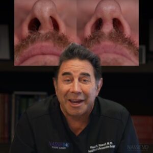 Paul Nassif Instagram - People always ask me what a deviated septum is! In this video, we see a great example of a caudal septal deviation and I explain how I was able to correct the deformity. 

Our patient is extremely happy with his incredible transformation and very grateful for the immediate and dramatic improvement in his breathing! 💜

🔊 Sound: On!

Trusted with Noses Worldwide®

_____________________________________________ 
☎️☎️ Call us at: 1 (310) 275-2467 
💌💌 Email us at: concierge@drpaulnassif.com 
 
#deviatedseptum #askthedoc #rhinoplasty #nosejob #rinoplastia #rinoplasti #nosesurgery #plasticsurgeon #rhinoplastyspecialist #cosmeticsurgery #primaryrhinoplasty #septoplasty #primaryseptoplasty
#rhinoplastybeforeandafter #facialplasticsurgery 
#rhinoplastydiary #bhfyp #tt #wednesday #beforeandafter #caudalseptaldeviation