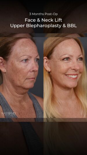 Paul Nassif Instagram - My incredible facial rejuvenation patient, Gwen, is only three months post-op from her upper blepharoplasty, deep plane facelift & neck lift!  

She also received BBL® (Broadband Light) at @NassifMedical.  

Nearly all of her swelling is gone at this point, but it will still take a couple more months to fully heal. She feels that her youthful outer appearance now matches how she felt on the inside and she doesn’t feel like she changed her face to a point where she’s unrecognizable! She told us that she now looks like how she used to nearly 15 years ago! 

She and I are thrilled with these unbelievable results!

Trusted with Faces Worldwide®  
_____________________________________________   
☎️☎️ Call us at: 1 (310) 275-2467   
💌💌 Email us at: concierge@drpaulnassif.com 

#nassifmedical #laser #bbl #broadbandlaser
#facialrejuvenation #blepharoplasty #upperblepharoplasty #deepplanefacelift #deepplanenecklift #beforeandafter #necklift #facelift #eyes #results
#plasticsurgeon #cosmeticsurgery #facialplasticsurgery #face #neck #antiaging #turningbacktheclock #tt #transformationtuesday