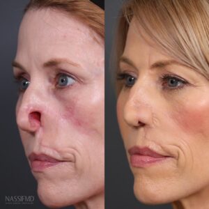 Paul Nassif Instagram - Who remembers Shelley from the Mid-Season Finale of Botched?! 

Here is a before and after of her results, which ended up being one of the most incredibly complex cases and heartfelt stories we’ve ever had on the show. 

Shelly had a rare form of skin cancer that led to multiple, horrific complications, which included a gaping hole in the side of her nose. Morpheaform basal cell carcinoma, which Shelley had, is an extremely rare form of the skin cancer I had. It can be a fast-growing basal cell that occurs underneath the skin.

In order to help her, we had to perform numerous surgeries, including the need to make a forehead flap! 

For more on Shelley’s incredible story, watch Botched Season 8, Episode 10: Doctor Nose Best on E! 

Trusted with Noses Worldwide® 
_____________________________________________ 
☎️ Call us at: 1 (310) 275-2467 
💌 Email us at: concierge@drpaulnassif.com 
 
#botched #rhinoplasty #revisionrhinoplasty #nosejob #rinoplastia #rinoplasti #septoplasty #nosesurgery #plasticsurgeon #rhinoplastyspecialist #cosmeticsurgery #transformation #revisionhinoplasty #revisionseptoplasty  #morpheaform #basalcell #carcinoma #rhinoplastybeforeandafter #beforeandafter #facialplasticsurgery #rhinoplastydiary #bhfyp #transformationtuesday #tt