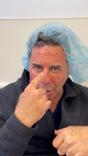 Paul Nassif Instagram - Skin Cancer Update! I know a lot of you wanted me to keep you updated, so here it is: 

Everything is going well so far after my procedures to remove the skin cancer. The worst side effect, as you can see, is the redness and uncomfortable dry skin from the laser treatments. Also, I’m going to start working on products and nutraceuticals that could help with DNA repair for those of us who have already done damage to our skin, but want to reduce the risk of getting skin cancer going forward. 

Thank you for all of the love and prayers; it means the world to me! I’ll continue to keep you updated and please remember to wear your sunscreen! ☀️🧴 
 
🔊 Sound: On! 

#skincancer #awareness #prevention #sunscreen #dermatologist #surgery #update