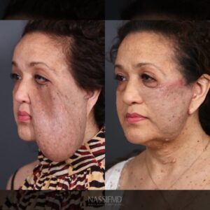 Paul Nassif Instagram - Here are the results from the incredible season finale of #Botched, which featured Yamile’s extraordinary story! As a reminder, Yamile’s case included a tumor excision, facelift, canthoplasty & more; it was definitely the biggest and toughest case we’ve ever had! She’s still recovering and will continue to heat, but we’re all extremely happy with her results so far! Thank you to the dream team that helped make this happen at Sharp Coronado Hospital and to all of you for your love and support! 💜

Note: The before and after is only three months post-op, while the following picture of us together, is almost at 1-year post-op! 

👏👏 A round of applause for the incredible team: 
@sharphealthcare 
@scottevansusc
@drjameschao
@prime_plastics_medspas 
@drjohnfrederick 
@plasticeyemd 
@botchedtv
@eentertainment

#thesharpexperience #tumor #facialtumorexcision #facelift #canthoplasty #transformation #lifechanging #inspirational #teamwork 
#rhinoplasty #rhinoplastyspecialist #transformation #tv #tvshow #newepisode #plasticsurgery #botchedplasticsurgery #seasonfinale #tt #transformationtuesday